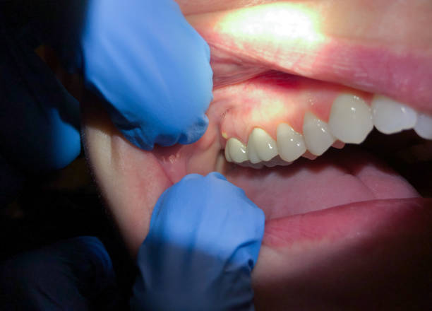 Best Broken or Cracked Tooth Emergency Dentist in Marion, NC
