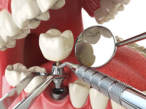 Best Broken or Cracked Tooth Emergency Dentist in Marion, NC