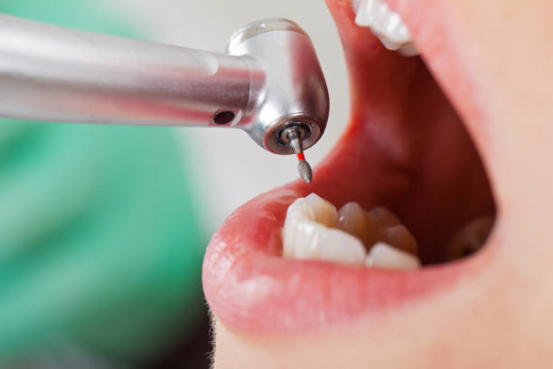 Best Emergency Dental Care for Abscessed Tooth in Marion, NC
